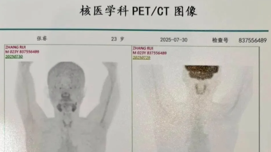 23岁博士确诊胃癌晚期：常熬夜压力大热搜配图